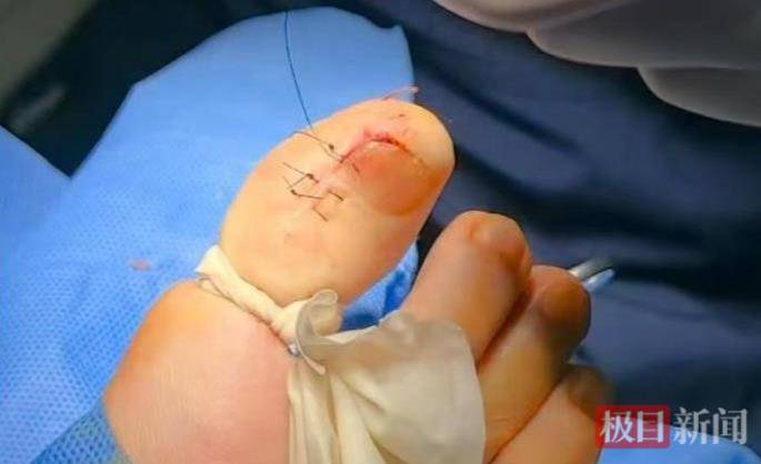 六旬女子被甲溝炎折磨了三年<strong></p>
<p>宏鑫機(jī)械設(shè)備有限公司
</strong>，專家30分鐘手術(shù)解難題:宏鑫機(jī)械設(shè)備有限公司
